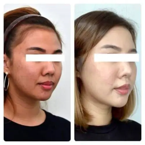 Buccal Fat Removal, right oblique, patient in her 20s, slimmer lower face, case 3