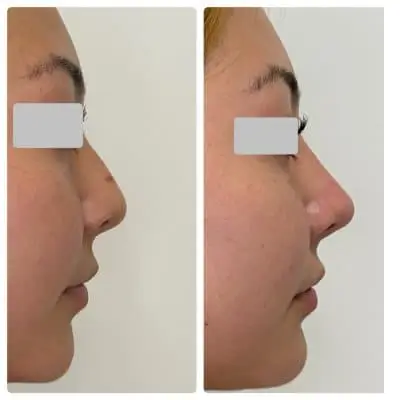 Non-surgical rhinoplasty, right profile, filler nose reshaping, case 1