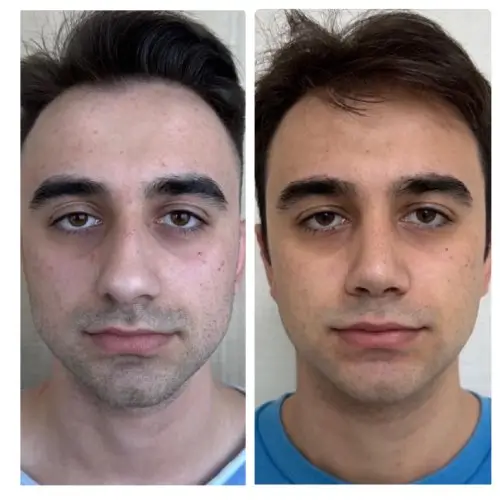 Rhinoplasty, front view, 1 year post-op, case 19