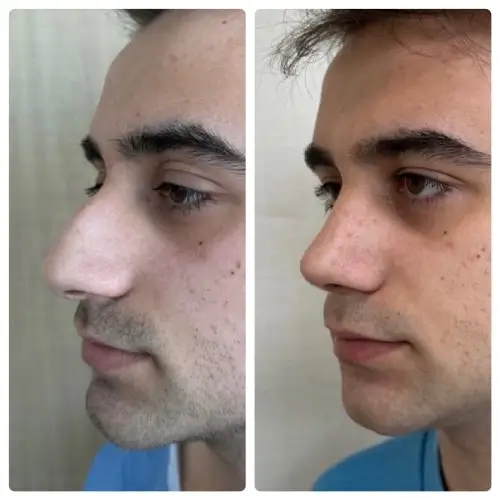 Rhinoplasty, left oblique, 1 year post-op, case 19