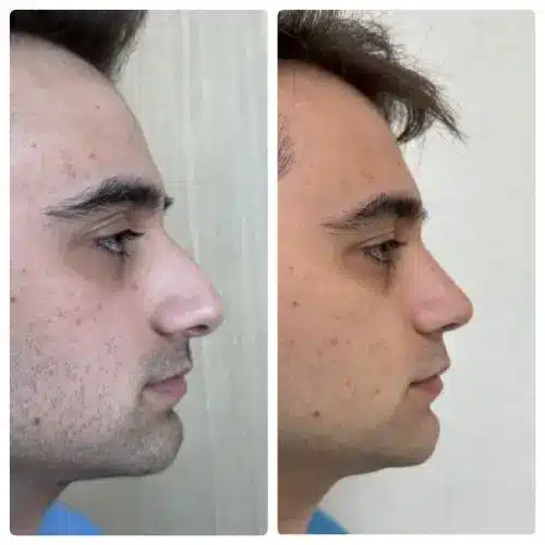 Rhinoplasty, right profile, 1 year post-op, case 19