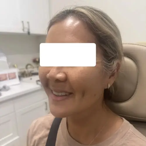 Dimple creation (dimpleplasty), left oblique, patient in her 40s, case 3