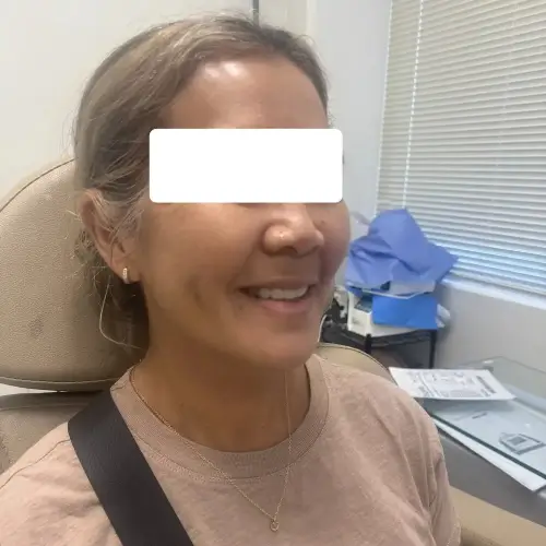 Dimple creation (dimpleplasty), right oblique, patient in her 40s, case 3
