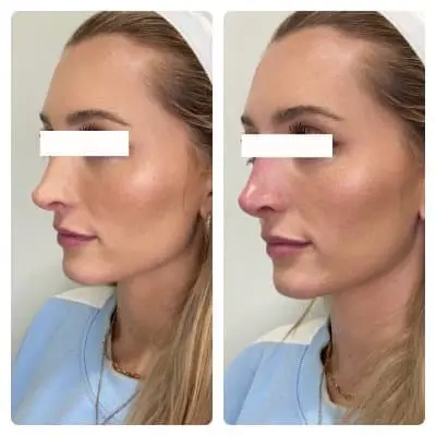 Non-surgical rhinoplasty, left oblique, filler nose reshaping, case 6