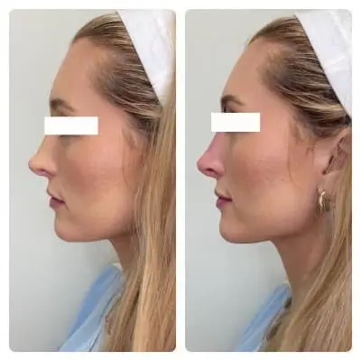 Non-surgical rhinoplasty, left profile, filler nose reshaping, case 6