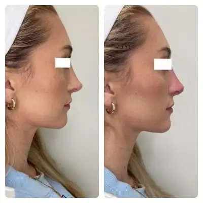 Non-surgical rhinoplasty, right profile, filler nose reshaping, case 6