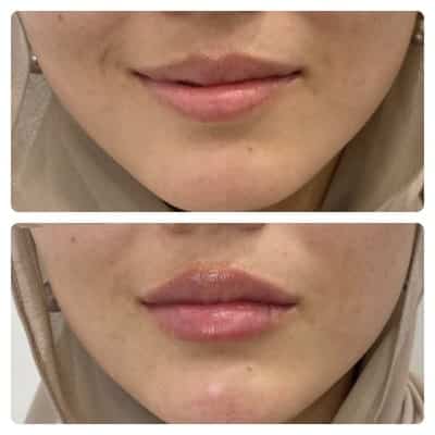 Lip filler enhancement, front view, patient 6