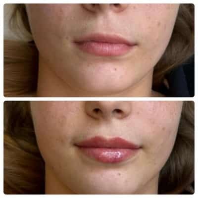 Lip filler enhancement, oblique view, patient 5