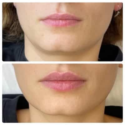 Lip filler enhancement, front view, patient 4
