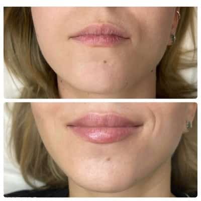 Lip filler enhancement, front view, patient 3