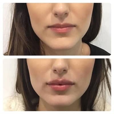 Lip filler enhancement, front view, patient 2