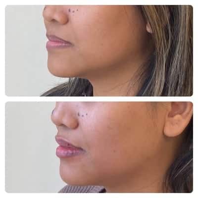 Lip filler enhancement, front view, patient 14