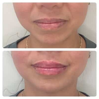 Lip filler enhancement, front view, patient 13