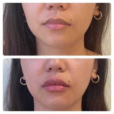 Lip filler enhancement, oblique view, patient 12