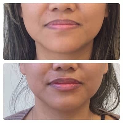 Lip filler enhancement, front view, patient 11
