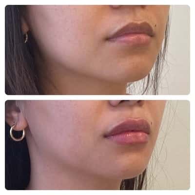 Lip filler enhancement, oblique view, patient 10
