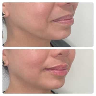 Lip filler enhancement, front view, patient 9