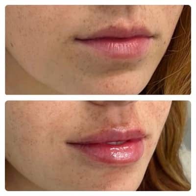 Lip filler enhancement, front view, patient 8