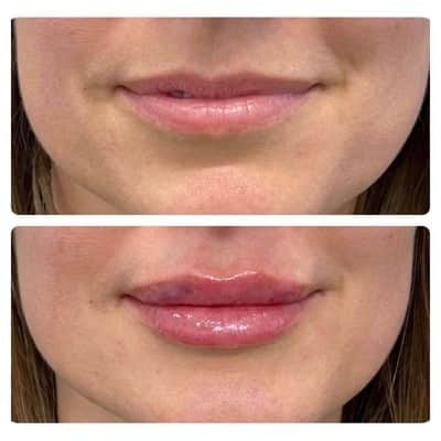 Lip filler enhancement, oblique view, patient 7