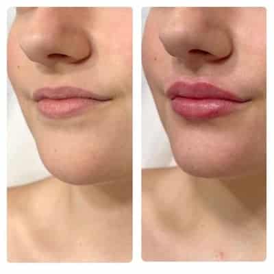 Lip filler enhancement, front view, patient 1