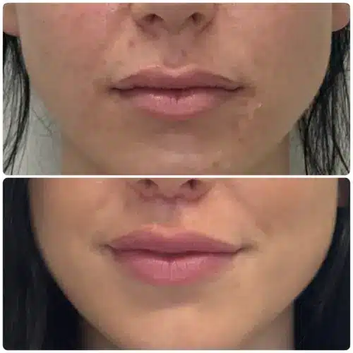 Subnasal lip lift, front view, patient in her 30s, result 4
