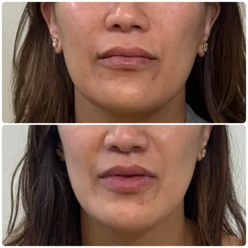 Subnasal lip lift, front view, patient in her 40s, result 3