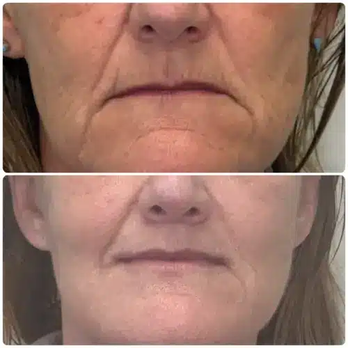 Subnasal lip lift with corner lip lift, front view, patient in her 60s, result 1