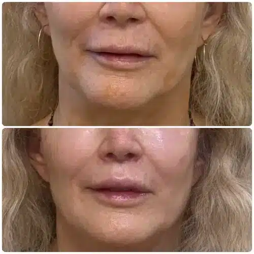 Subnasal lip lift, front view, patient in her 60s, result 2