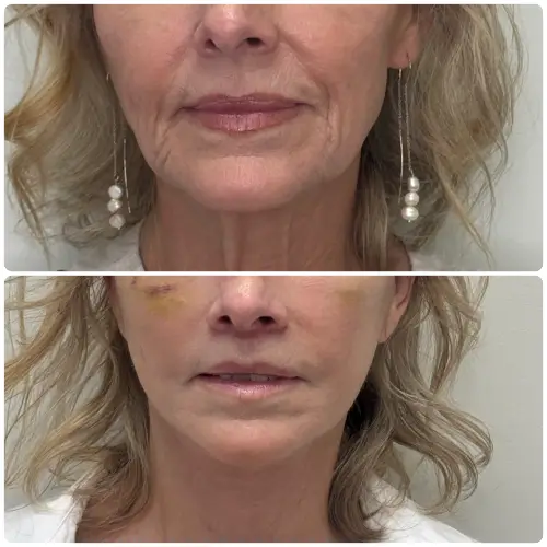 Subnasal lip lift, front view, patient in her 50s, result 6