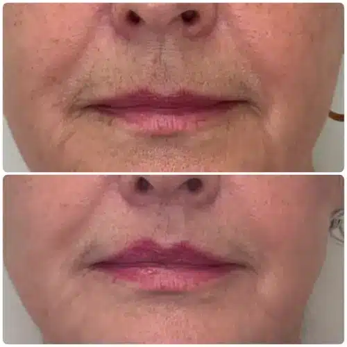 Subnasal lip lift, front view, patient in her 60s, result 5