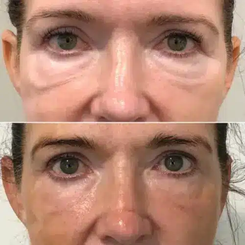 Morpheus8 RF microneedling, profile view, result 4
