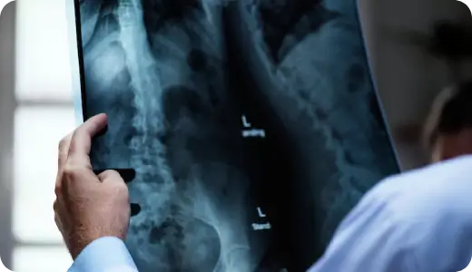Compression fracture collapse of spinal vertebra