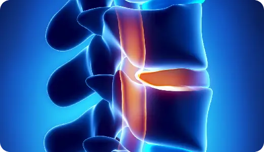 Epidural steroid injection for spine pain relief