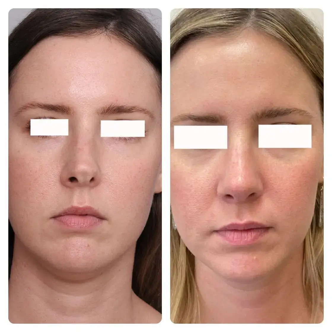 Surgical Rhinoplasty (Nose Surgery) Treatment