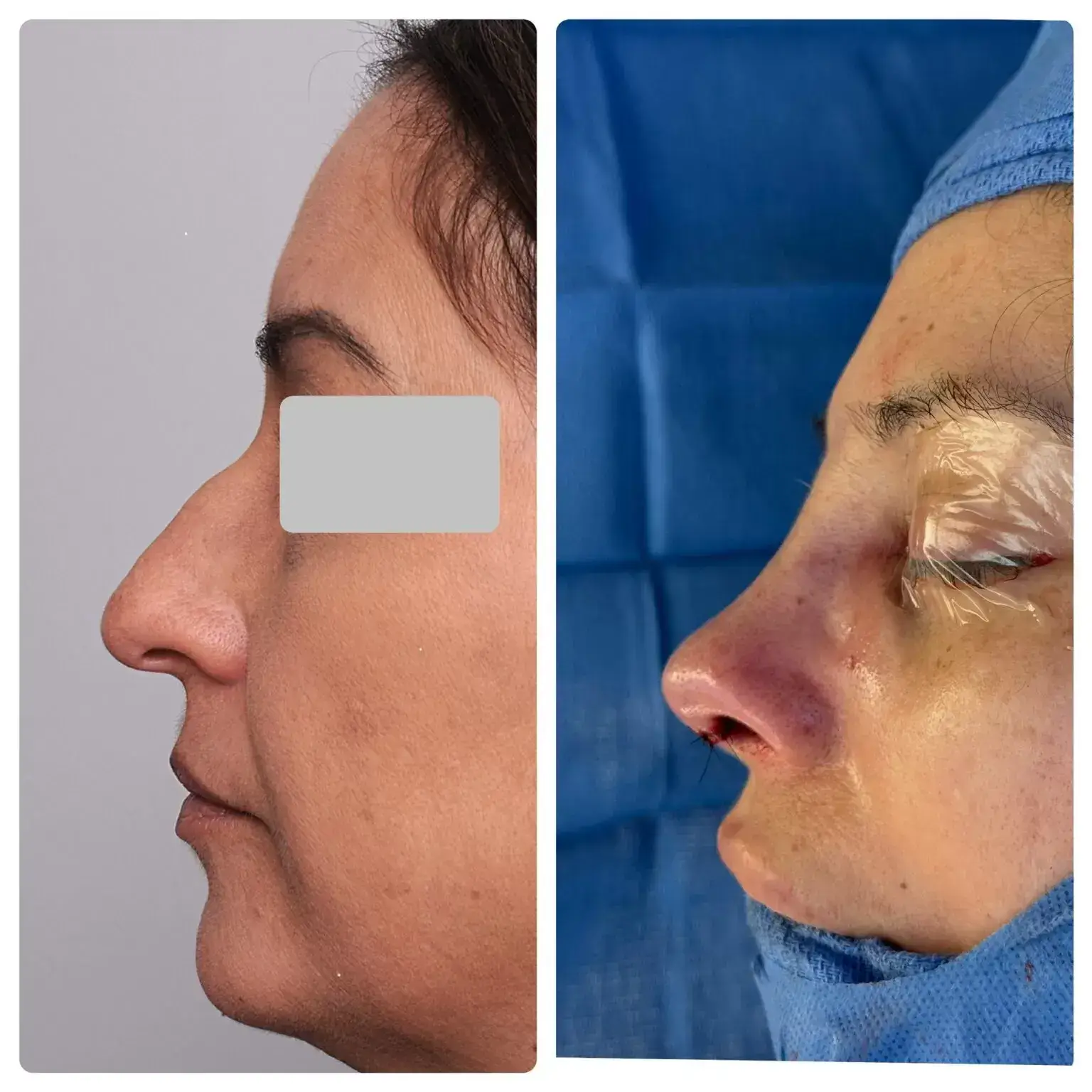 Surgical Rhinoplasty (Nose Surgery) Treatment