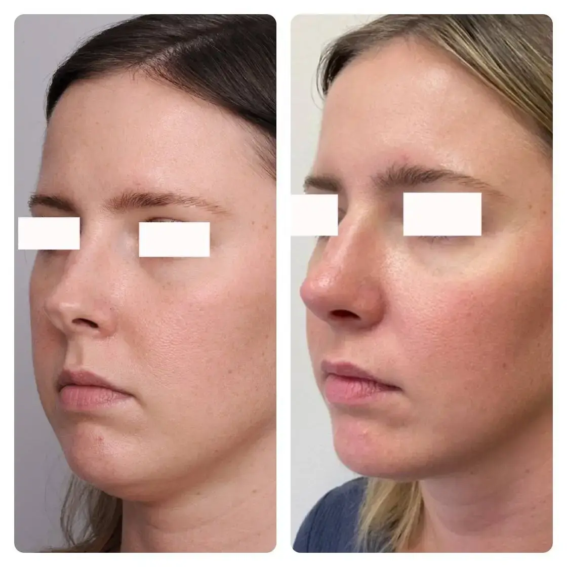 Surgical Rhinoplasty (Nose Surgery) Treatment