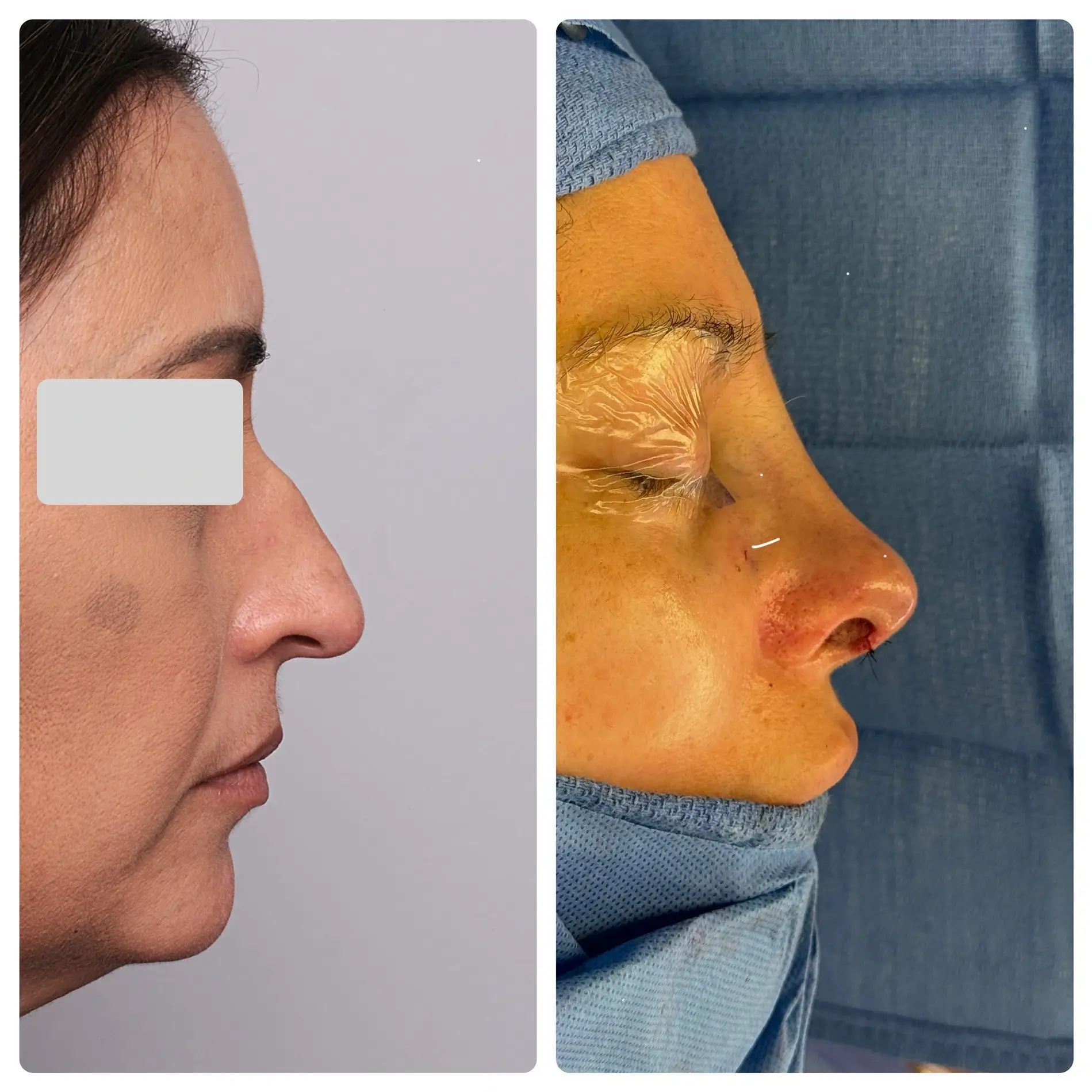 Surgical Rhinoplasty (Nose Surgery) Treatment