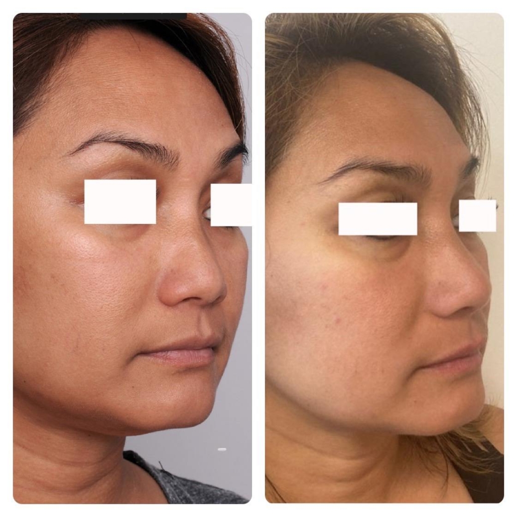 Surgical rhinoplasty, Oahu. Hawaii Facial Plastic Surgery.
