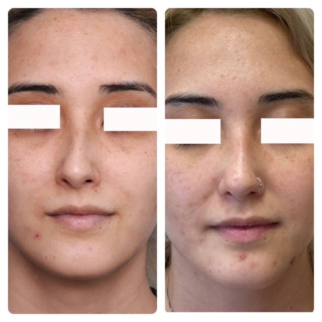 Nose surgery, Oahu, before and after nose job surgical procedure.