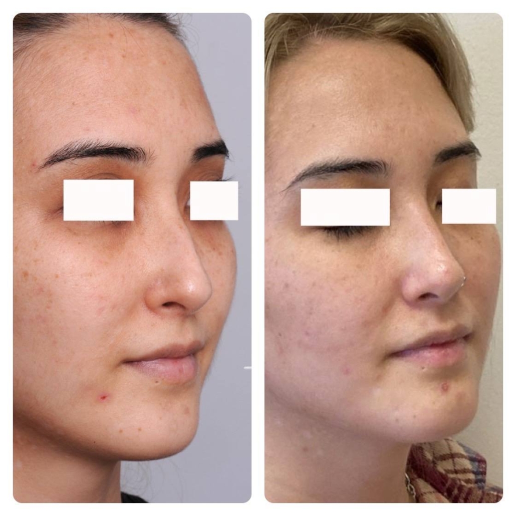 Surgical rhinoplasty, Oahu. Hawaii Facial Plastic Surgery.