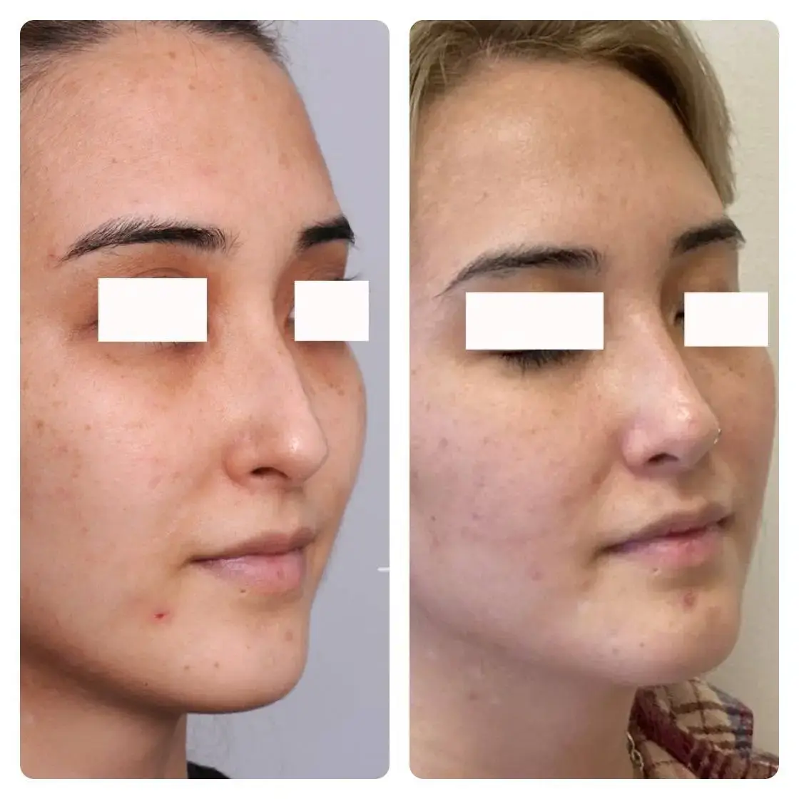 Surgical Rhinoplasty (Nose Surgery) Treatment