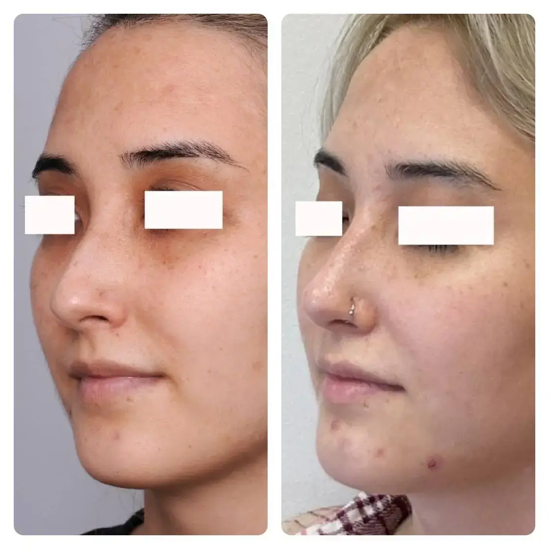 Surgical Rhinoplasty (Nose Surgery) Treatment
