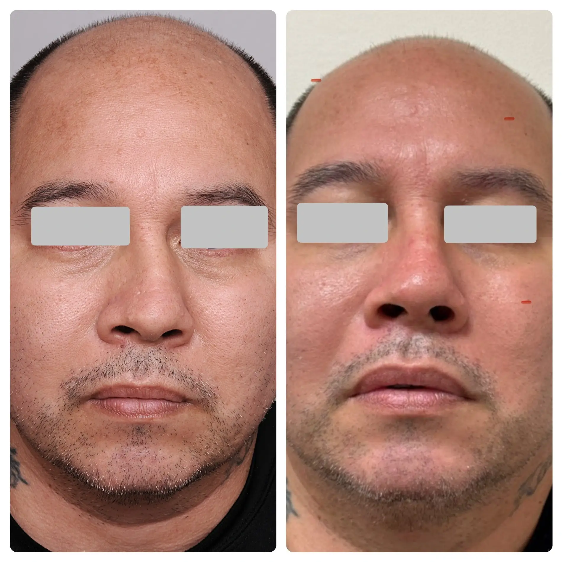 Surgical Rhinoplasty (Nose Surgery) Treatment