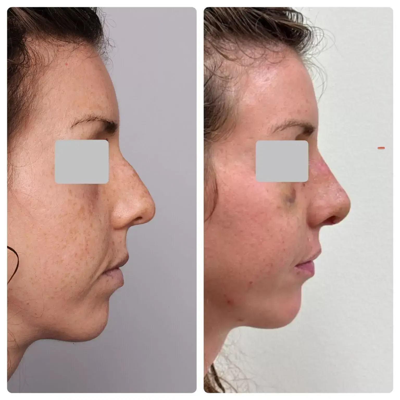 Surgical Rhinoplasty (Nose Surgery) Treatment