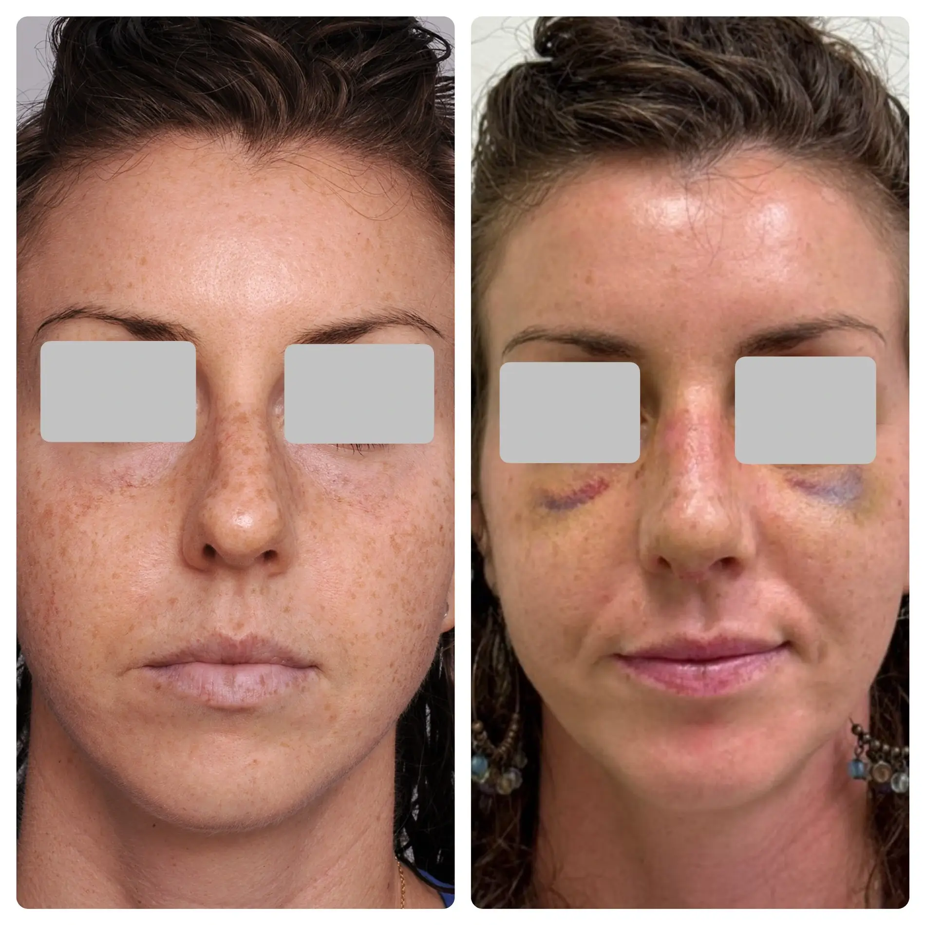 Surgical Rhinoplasty (Nose Surgery) Treatment