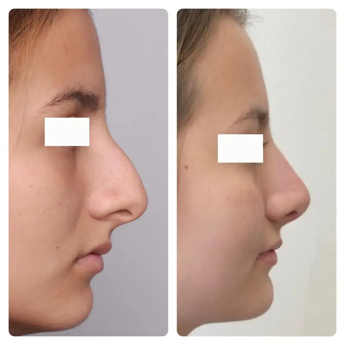 Surgical Rhinoplasty (Nose Surgery) Treatment