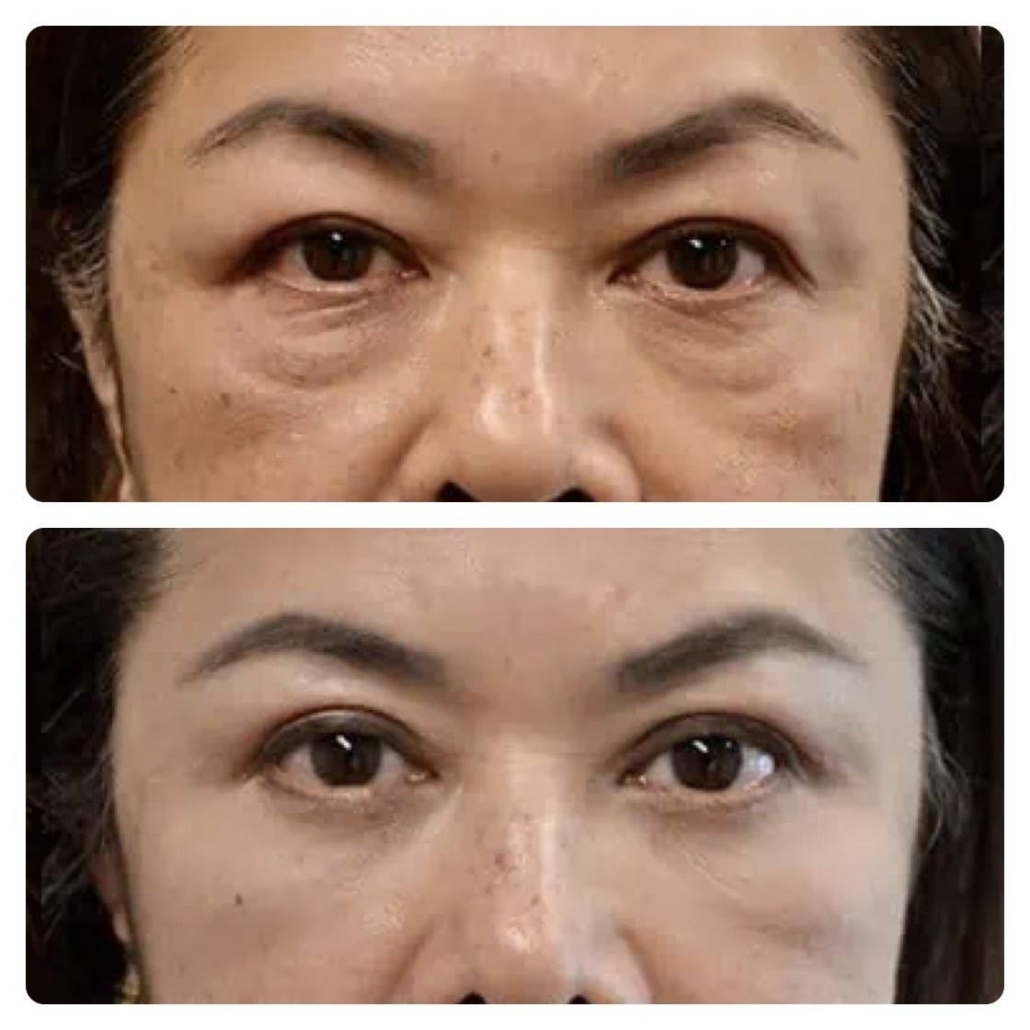 IMG_7662 Choosing a Honolulu Plastic Surgeon for Your Eyelid Lift