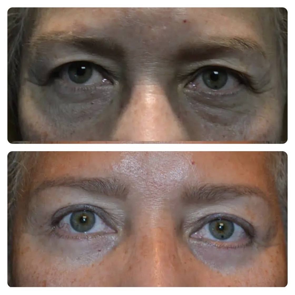 IMG_7674 Choosing a Honolulu Plastic Surgeon for Your Eyelid Lift