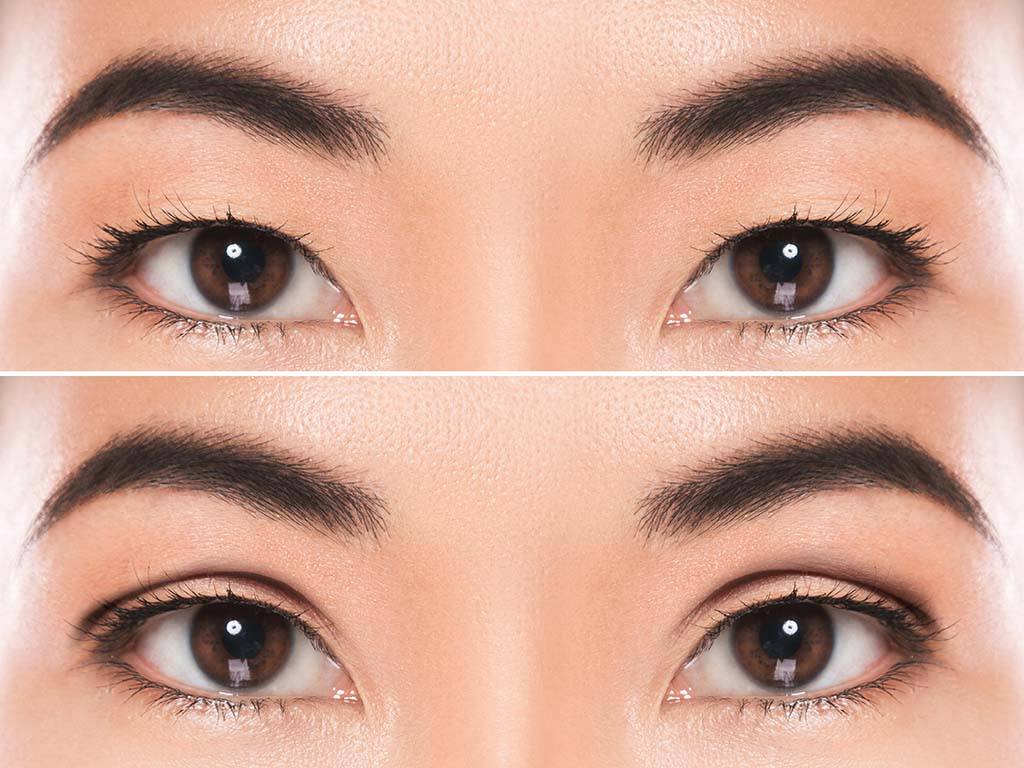 asian-before-after-0001 Facelift patient preparing for a deep plane facelift procedure.