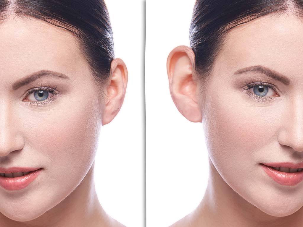 Before and after of Oahu buccal face removal surgery, Honolulu, HI.